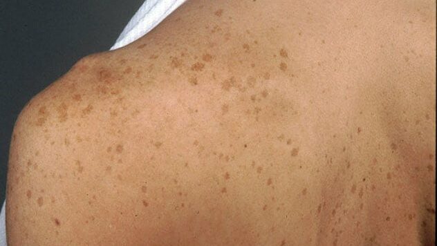 Age Spots On The Shoulder And Back Edited (1)