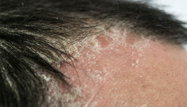 22828 Scalp Psoriasis 1127052066 1