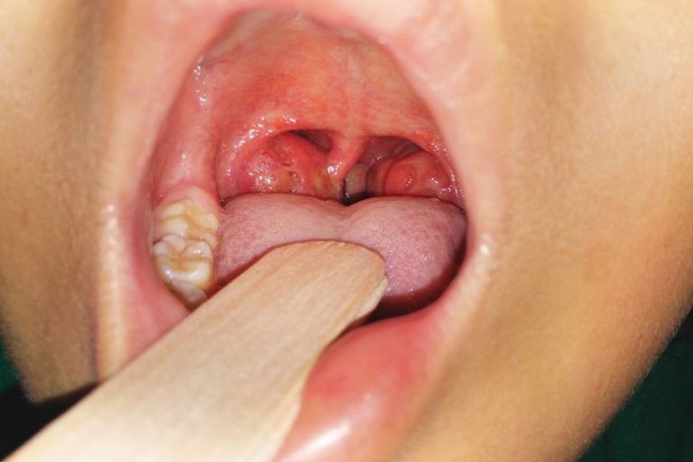 Tonsillitis In Child