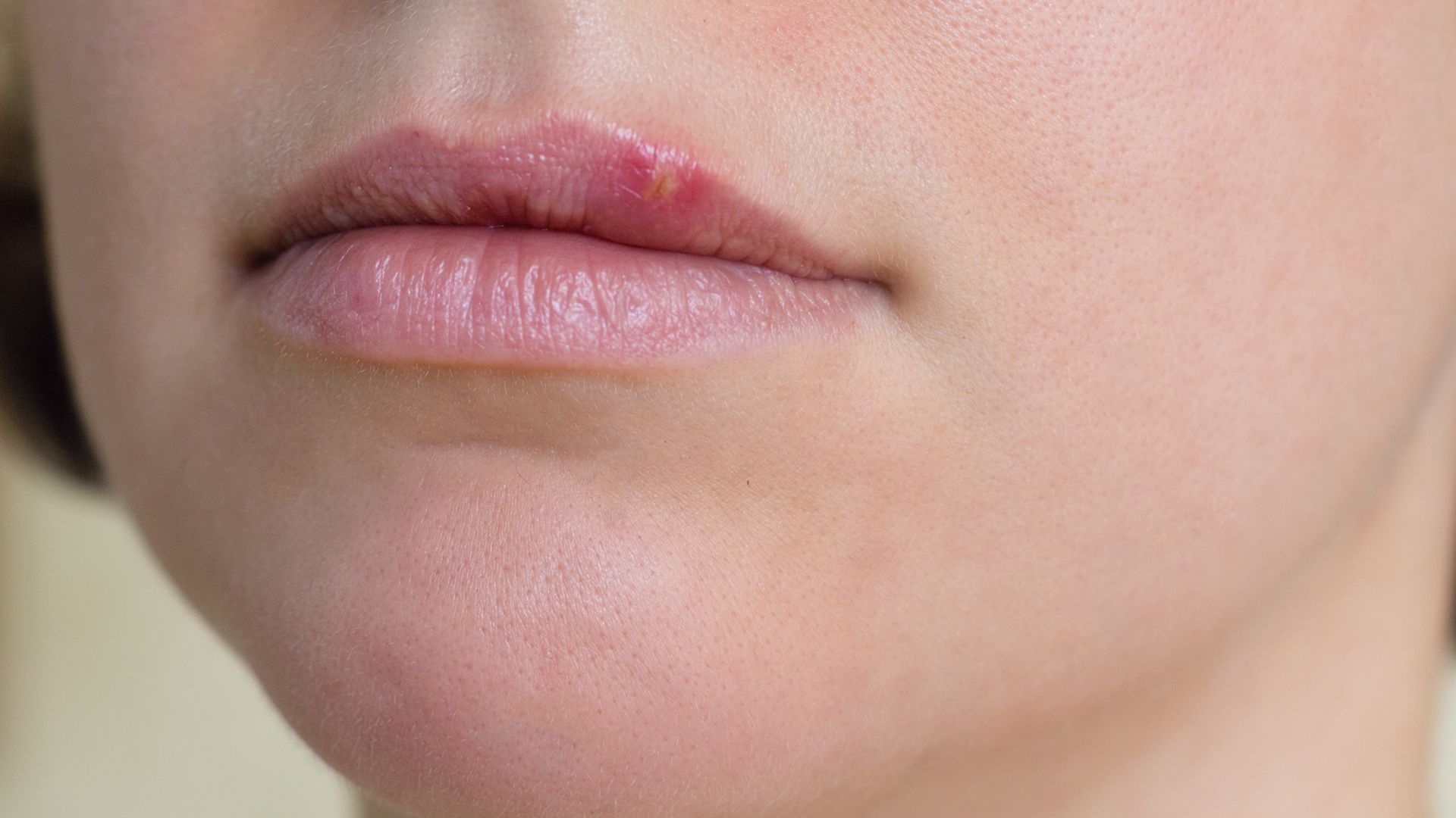 Herpes Labialis