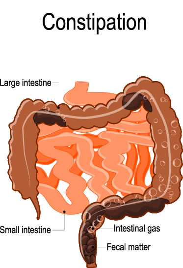 Cause Treatment Of Constipation 1