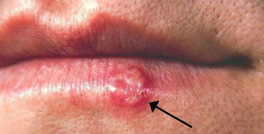 Herpes Labiale Base Di Aglio