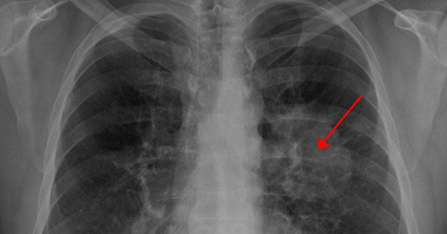 Lung Cancer 650